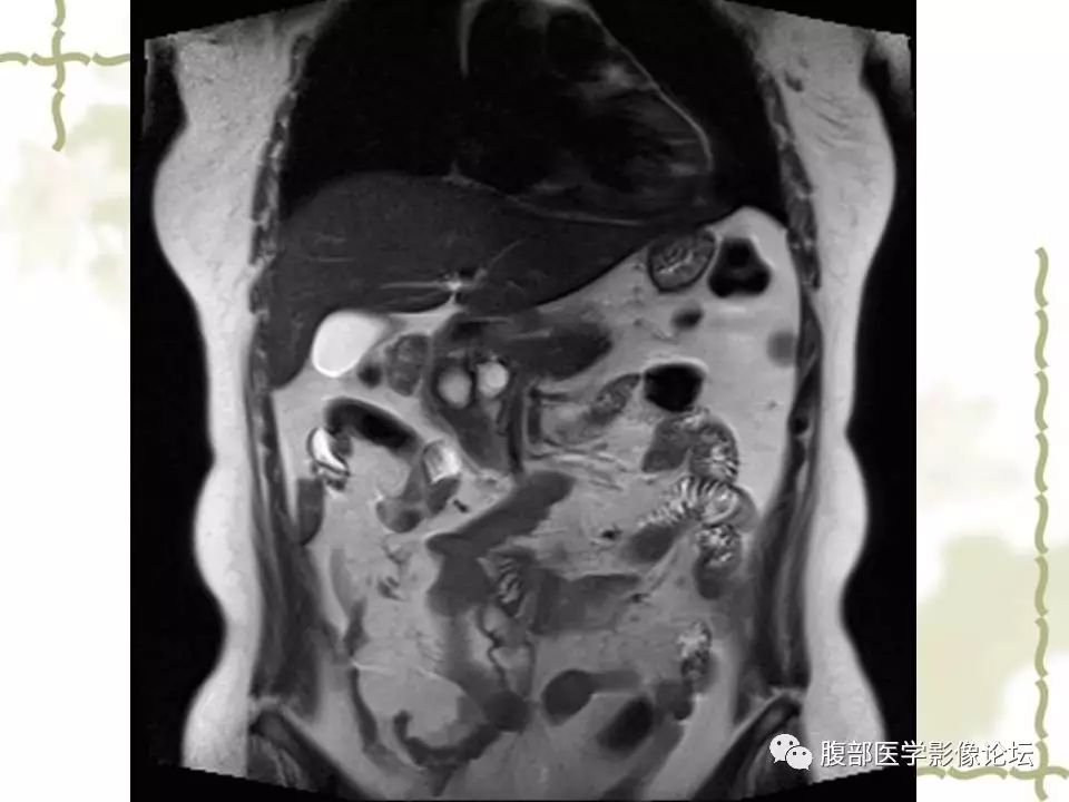 【病例】胰头浆液性囊腺瘤1例CT及MR 【病例】胰头浆液性囊腺瘤1例CT及MR