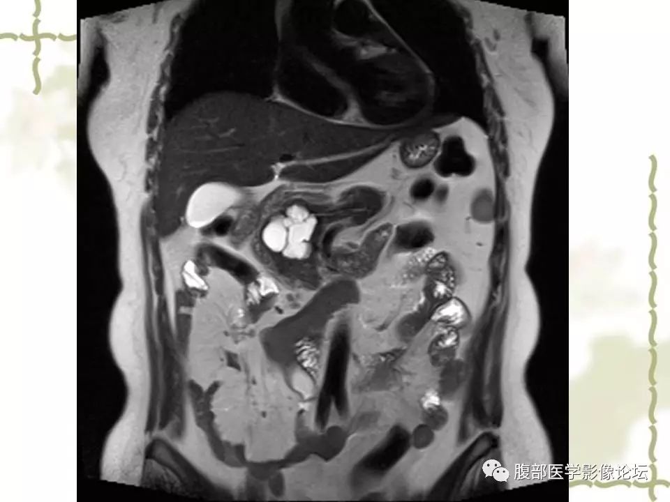 【病例】胰头浆液性囊腺瘤1例CT及MR 【病例】胰头浆液性囊腺瘤1例CT及MR