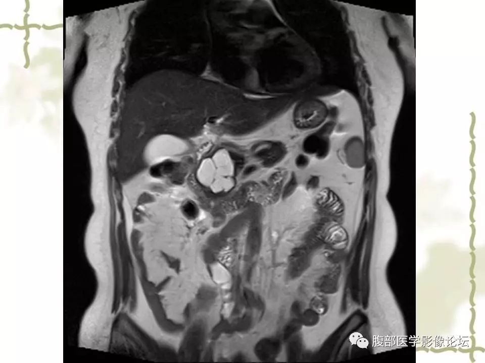 【病例】胰头浆液性囊腺瘤1例CT及MR 【病例】胰头浆液性囊腺瘤1例CT及MR