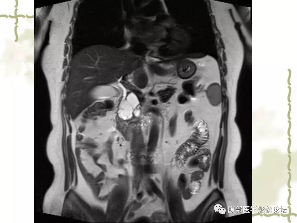 【病例】胰头浆液性囊腺瘤1例CT及MR 【病例】胰头浆液性囊腺瘤1例CT及MR