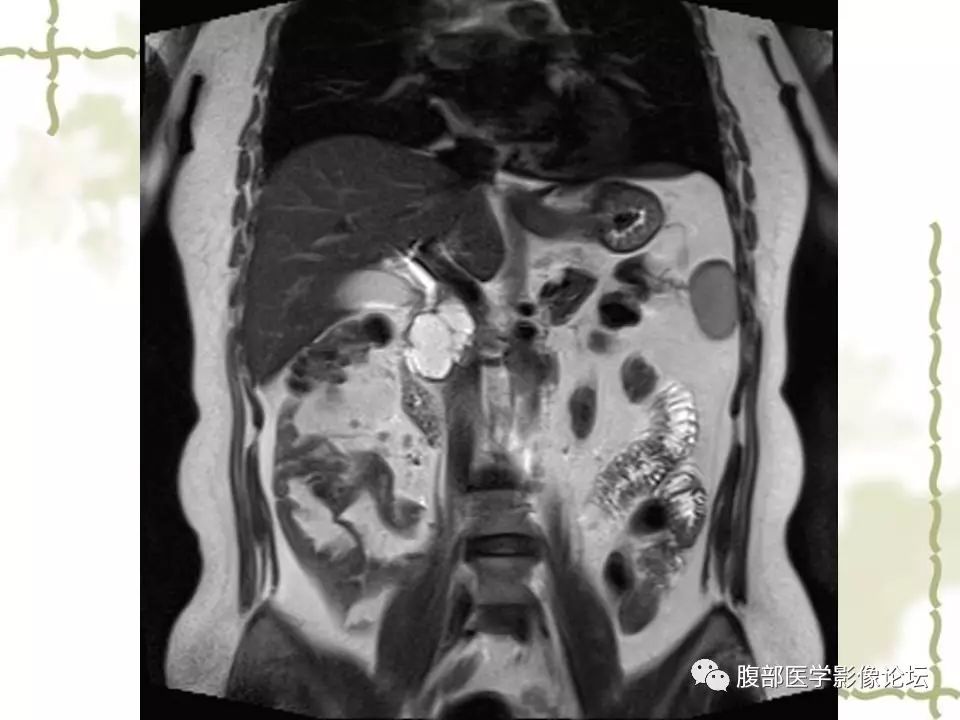 【病例】胰头浆液性囊腺瘤1例CT及MR 【病例】胰头浆液性囊腺瘤1例CT及MR
