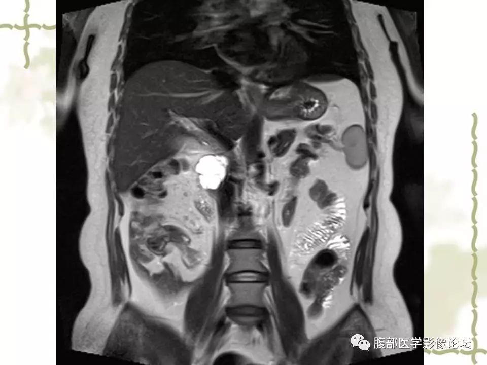 【病例】胰头浆液性囊腺瘤1例CT及MR 【病例】胰头浆液性囊腺瘤1例CT及MR