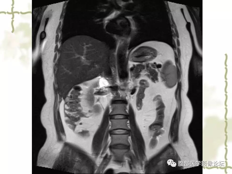 【病例】胰头浆液性囊腺瘤1例CT及MR 【病例】胰头浆液性囊腺瘤1例CT及MR