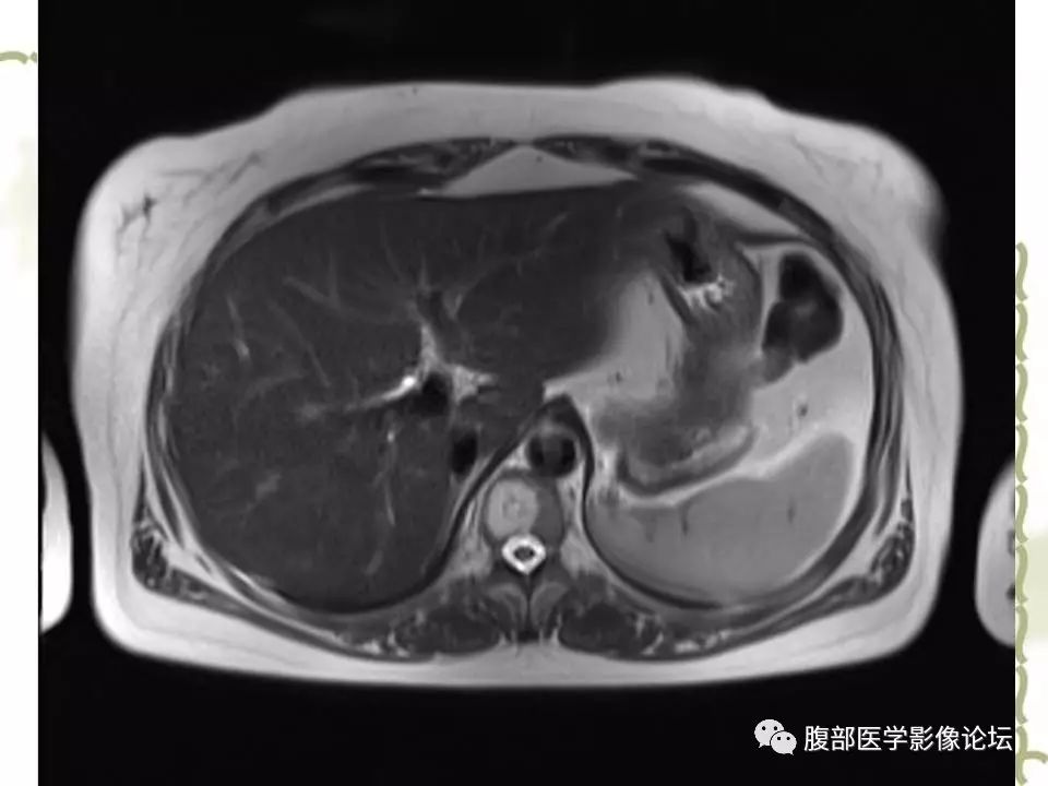 【病例】胰头浆液性囊腺瘤1例CT及MR 【病例】胰头浆液性囊腺瘤1例CT及MR
