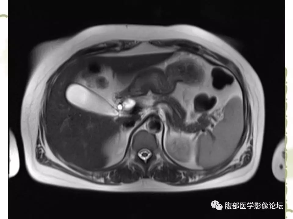 【病例】胰头浆液性囊腺瘤1例CT及MR 【病例】胰头浆液性囊腺瘤1例CT及MR