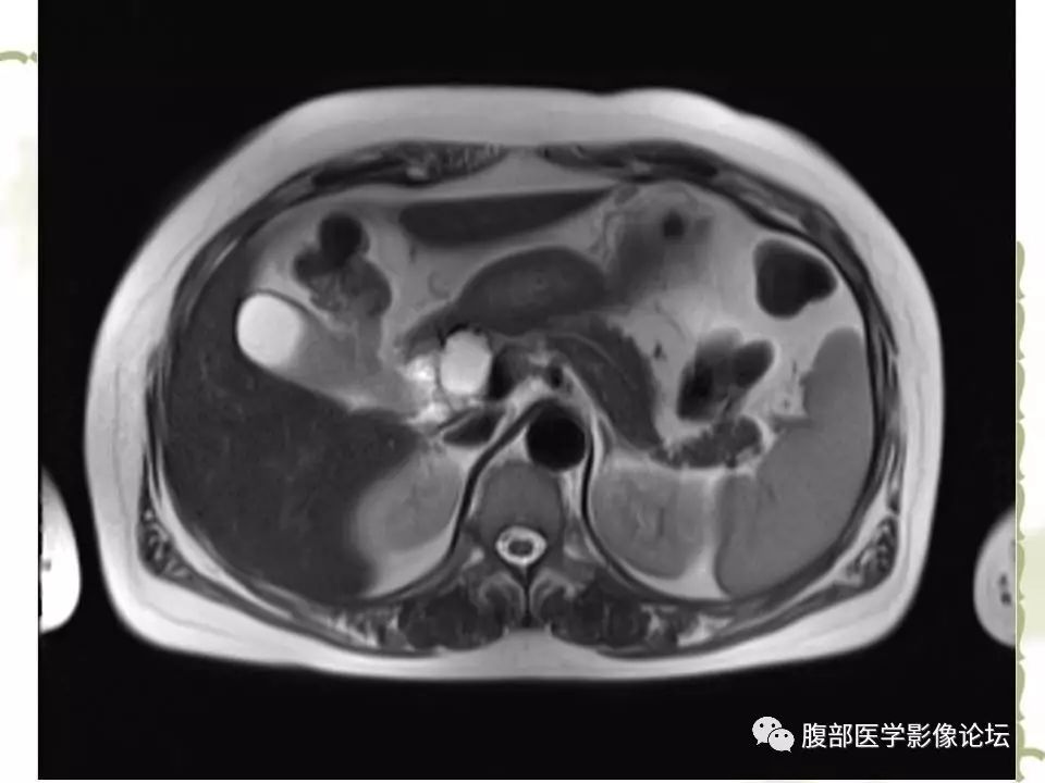【病例】胰头浆液性囊腺瘤1例CT及MR 【病例】胰头浆液性囊腺瘤1例CT及MR