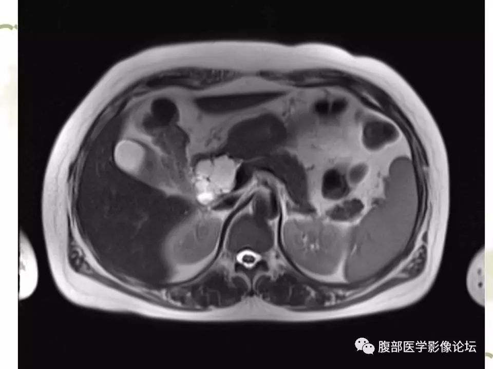 【病例】胰头浆液性囊腺瘤1例CT及MR 【病例】胰头浆液性囊腺瘤1例CT及MR