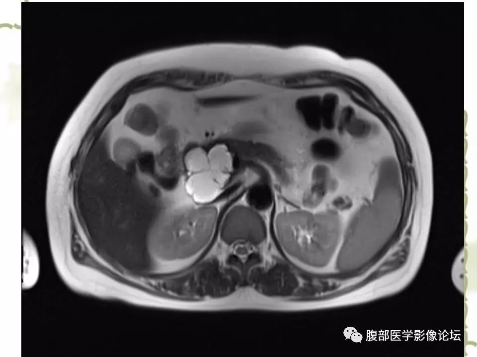 【病例】胰头浆液性囊腺瘤1例CT及MR 【病例】胰头浆液性囊腺瘤1例CT及MR