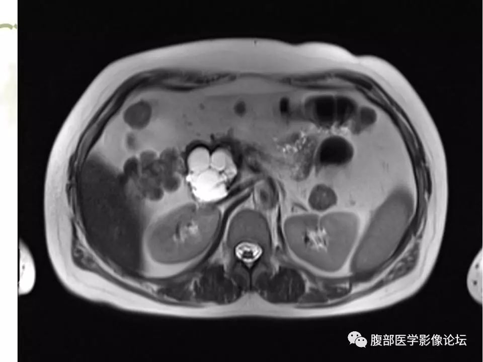 【病例】胰头浆液性囊腺瘤1例CT及MR 【病例】胰头浆液性囊腺瘤1例CT及MR