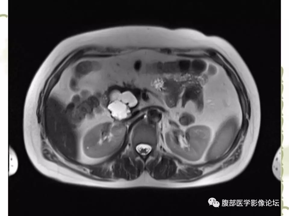 【病例】胰头浆液性囊腺瘤1例CT及MR 【病例】胰头浆液性囊腺瘤1例CT及MR