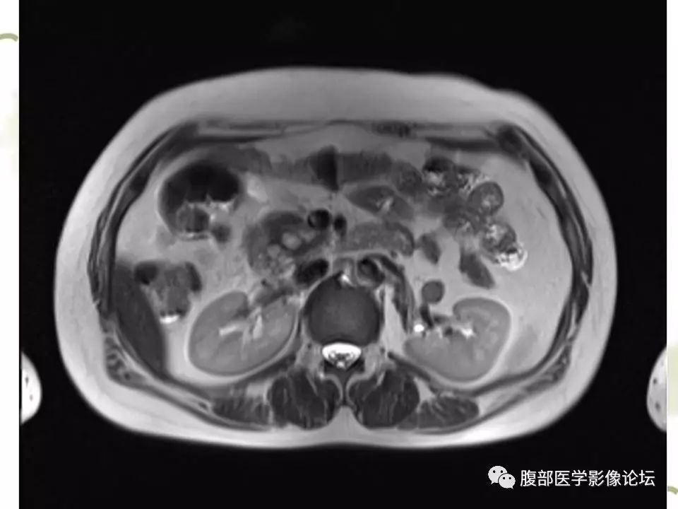【病例】胰头浆液性囊腺瘤1例CT及MR 【病例】胰头浆液性囊腺瘤1例CT及MR