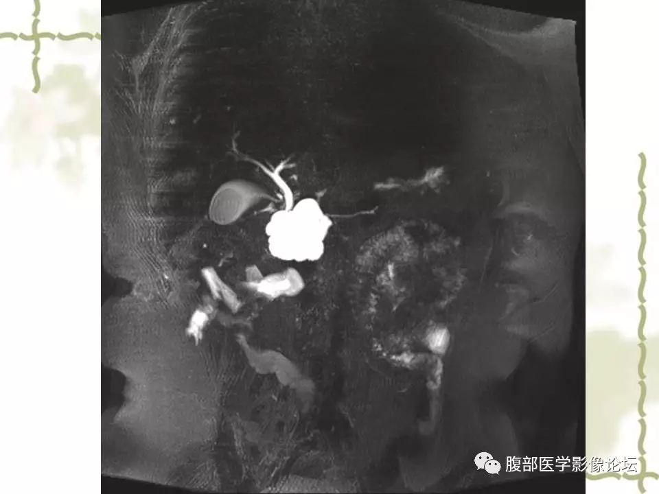 【病例】胰头浆液性囊腺瘤1例CT及MR 【病例】胰头浆液性囊腺瘤1例CT及MR