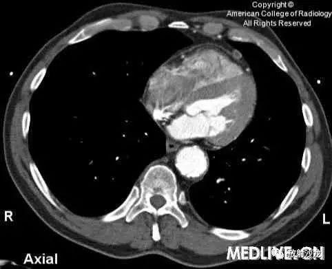 【病例】心包脂肪坏死一例CT 【病例】心包脂肪坏死一例CT