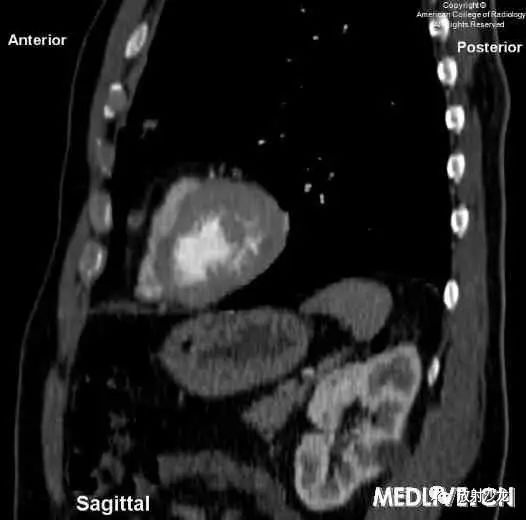 【病例】心包脂肪坏死一例CT 【病例】心包脂肪坏死一例CT