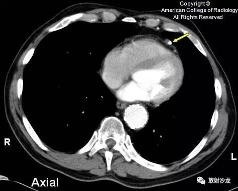 【病例】心包脂肪坏死一例CT 【病例】心包脂肪坏死一例CT