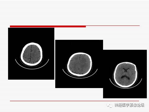 【病例】中枢神经系统淋巴瘤一例MR 【病例】中枢神经系统淋巴瘤一例MR