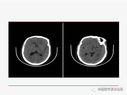 【病例】中枢神经系统淋巴瘤一例MR 【病例】中枢神经系统淋巴瘤一例MR