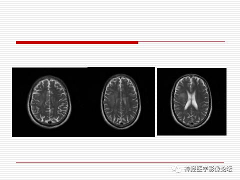 【病例】中枢神经系统淋巴瘤一例MR 【病例】中枢神经系统淋巴瘤一例MR