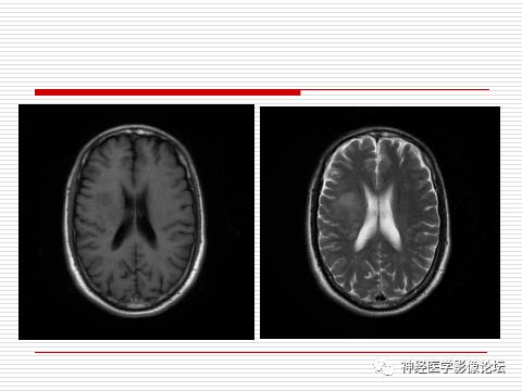 【病例】中枢神经系统淋巴瘤一例MR 【病例】中枢神经系统淋巴瘤一例MR