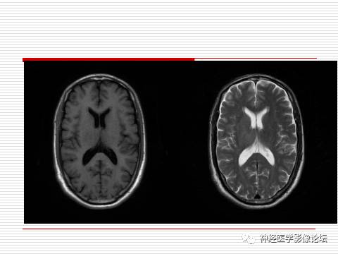【病例】中枢神经系统淋巴瘤一例MR 【病例】中枢神经系统淋巴瘤一例MR