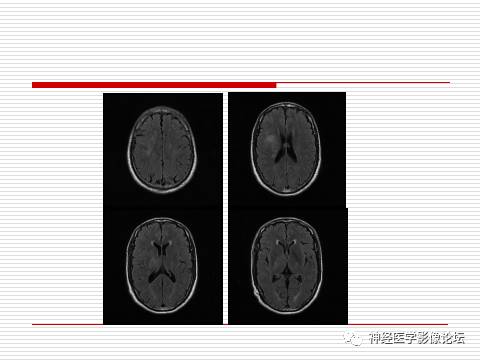 【病例】中枢神经系统淋巴瘤一例MR 【病例】中枢神经系统淋巴瘤一例MR