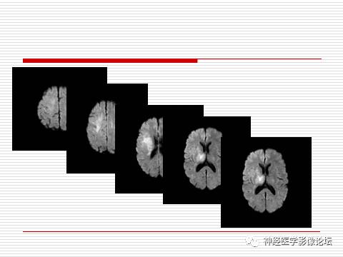 【病例】中枢神经系统淋巴瘤一例MR 【病例】中枢神经系统淋巴瘤一例MR