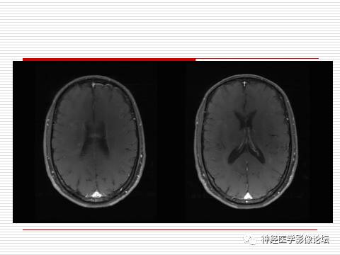 【病例】中枢神经系统淋巴瘤一例MR 【病例】中枢神经系统淋巴瘤一例MR