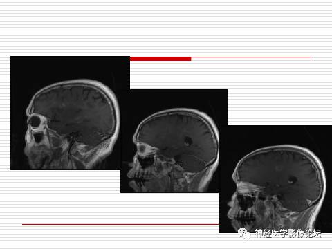 【病例】中枢神经系统淋巴瘤一例MR 【病例】中枢神经系统淋巴瘤一例MR