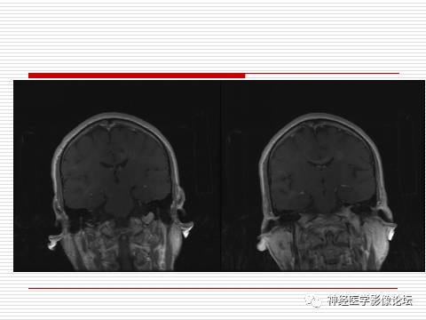 【病例】中枢神经系统淋巴瘤一例MR 【病例】中枢神经系统淋巴瘤一例MR