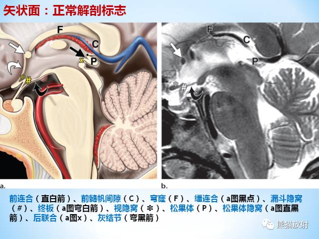 【PPT】三脑室病变的MRI表现