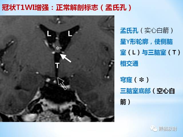 【PPT】三脑室病变的MRI表现