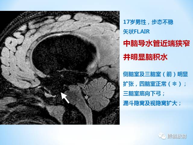 【PPT】三脑室病变的MRI表现