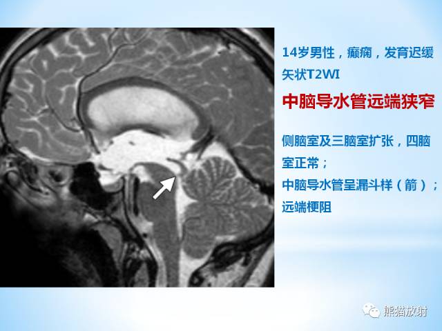 【PPT】三脑室病变的MRI表现