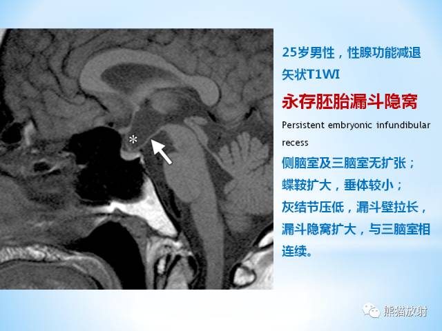 【PPT】三脑室病变的MRI表现