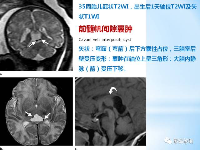【PPT】三脑室病变的MRI表现