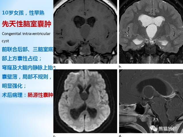 【PPT】三脑室病变的MRI表现