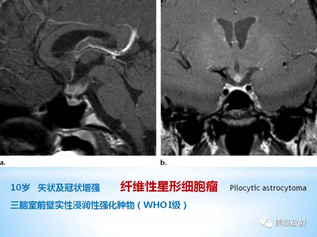 【PPT】三脑室病变的MRI表现