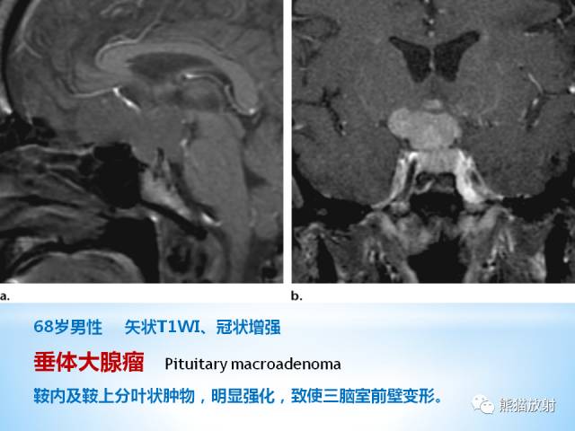 【PPT】三脑室病变的MRI表现