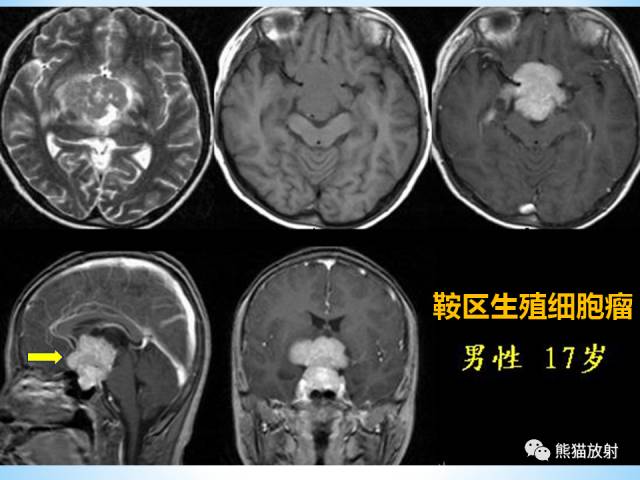 【PPT】三脑室病变的MRI表现