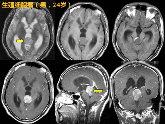 【PPT】三脑室病变的MRI表现