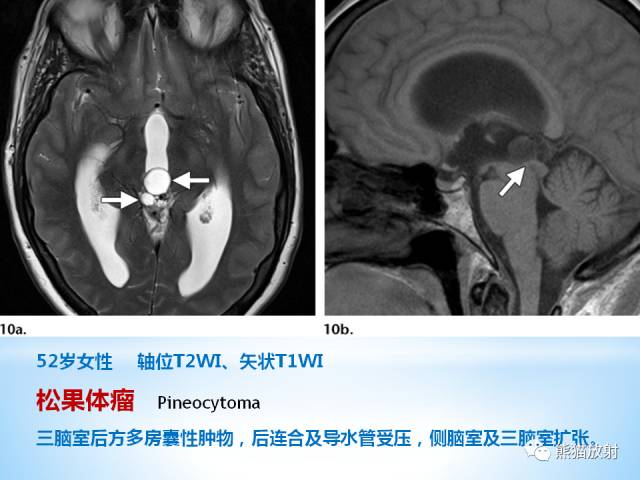【PPT】三脑室病变的MRI表现