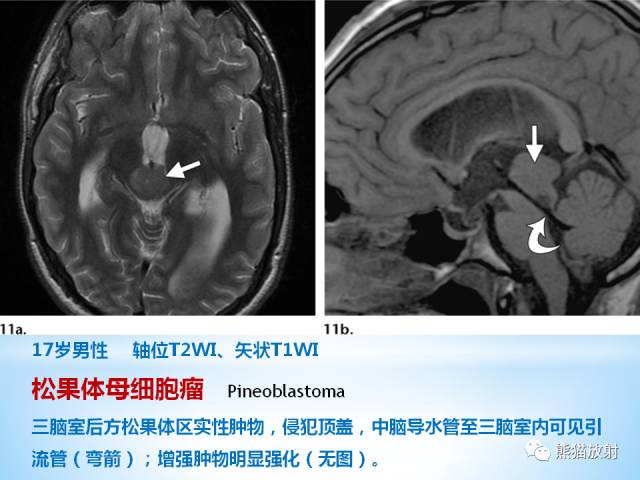 【PPT】三脑室病变的MRI表现