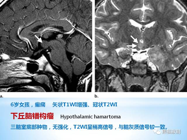 【PPT】三脑室病变的MRI表现