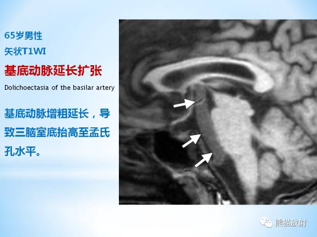 【PPT】三脑室病变的MRI表现