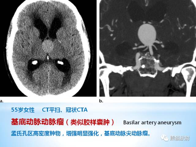 【PPT】三脑室病变的MRI表现