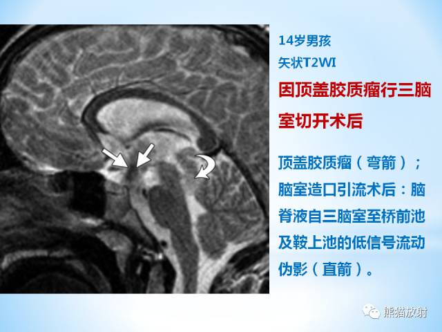 【PPT】三脑室病变的MRI表现