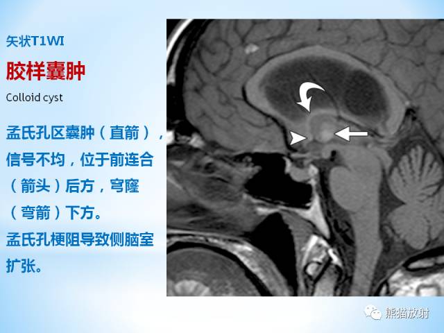 【PPT】三脑室病变的MRI表现