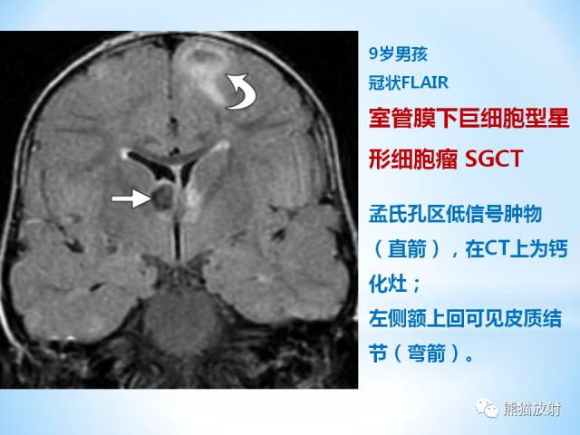 【PPT】三脑室病变的MRI表现