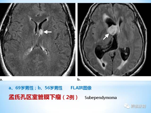 【PPT】三脑室病变的MRI表现