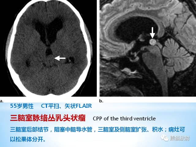 【PPT】三脑室病变的MRI表现
